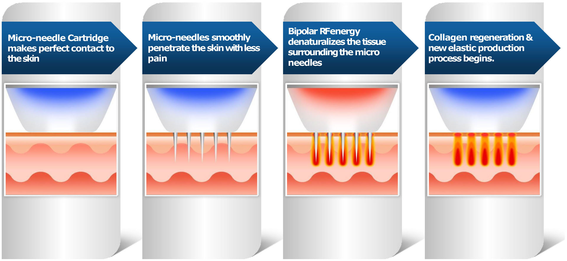 RF MICRONEEDLING.jpg