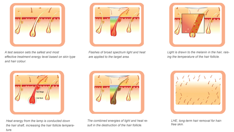 Laser_Hair_Removal.png Laser_Hair_Removal.png